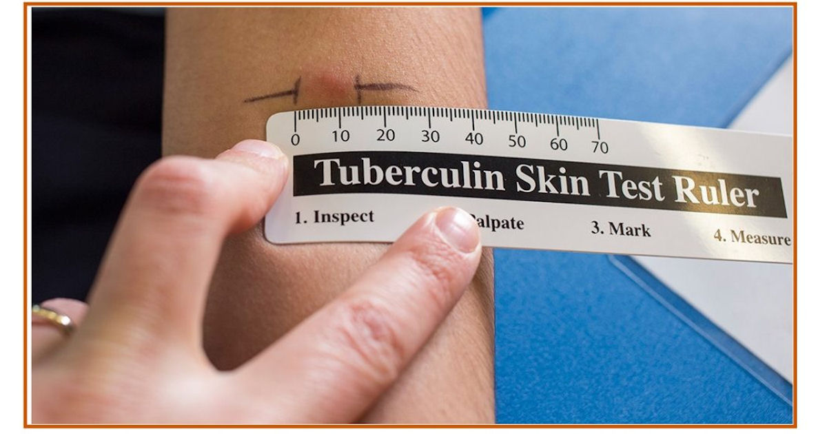 Actual Size Downloadable Tb Skin Test Ruler Printable